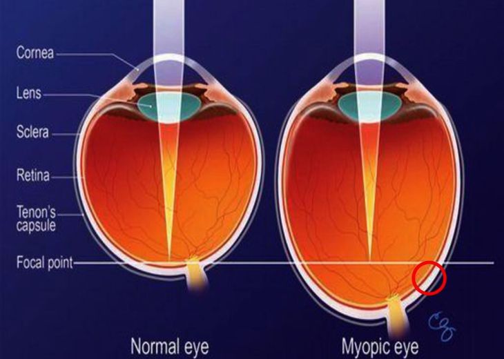 Lähinäyttöjen katselu rasittaa silmiä ja altistaa likinäköisyydelle: Miten hoidat silmiäsi ja milloin on syytä hakeutua silmälääkäriin?